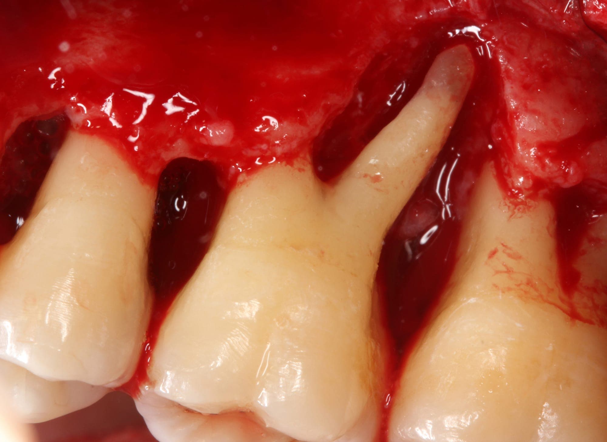 Periodontal Yıkım