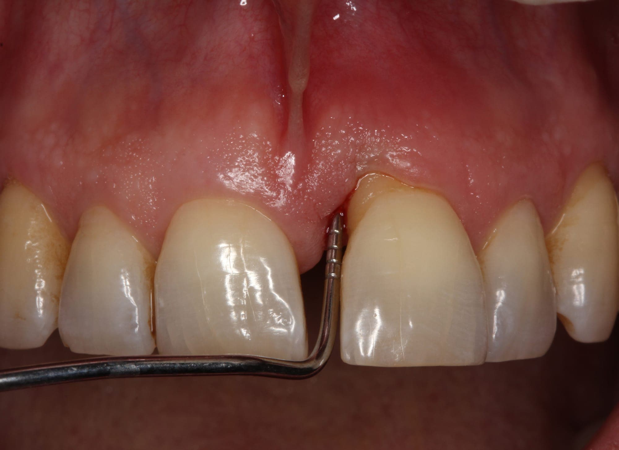 Periodontal Cep Ölçümü