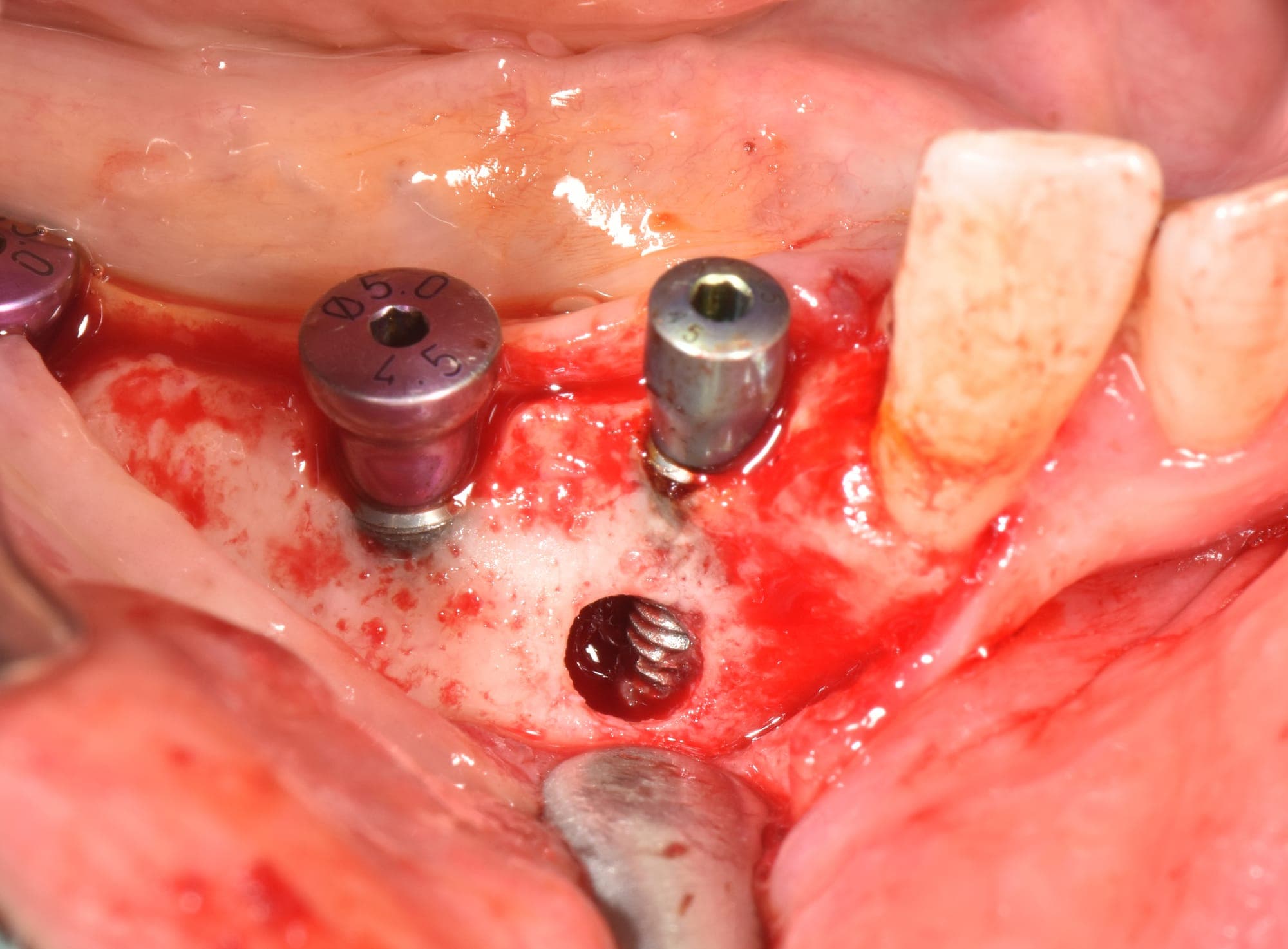 Peri-implant Fenestrasyon