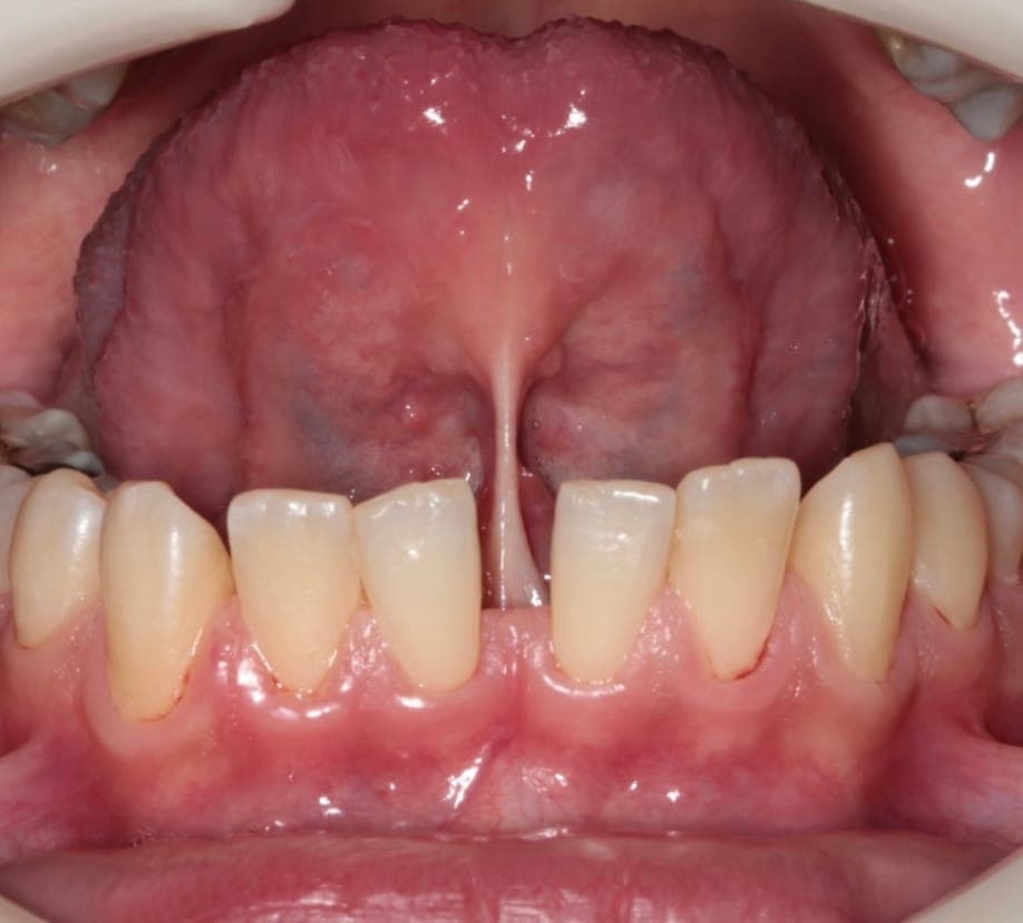 Lingual Frenulum Diastema
